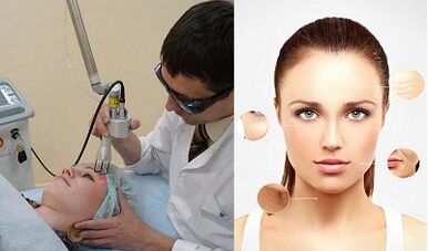 ¿Cómo funciona el rejuvenecimiento cutáneo con láser