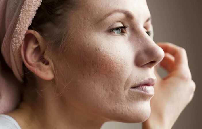 Piel facial problemática que requiere tratamientos antienvejecimiento