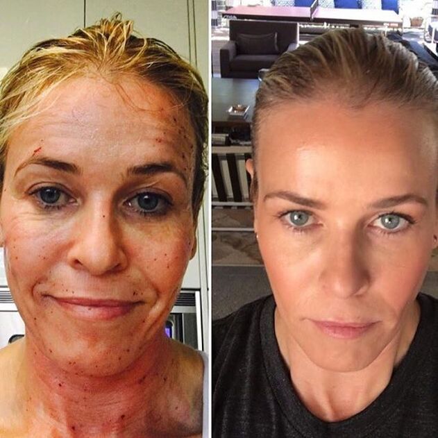 Mujer antes y después del láser fraccionado (deshágase de los focos de hiperpigmentación)